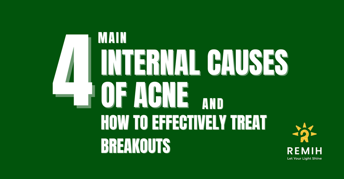 Main Internal Causes of Acne and How to Effectively Treat Breakouts