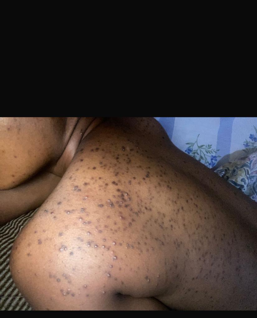 Fungal Acne: What It Is, How to Recognise It & Why Your Acne Routine May Not Be Working