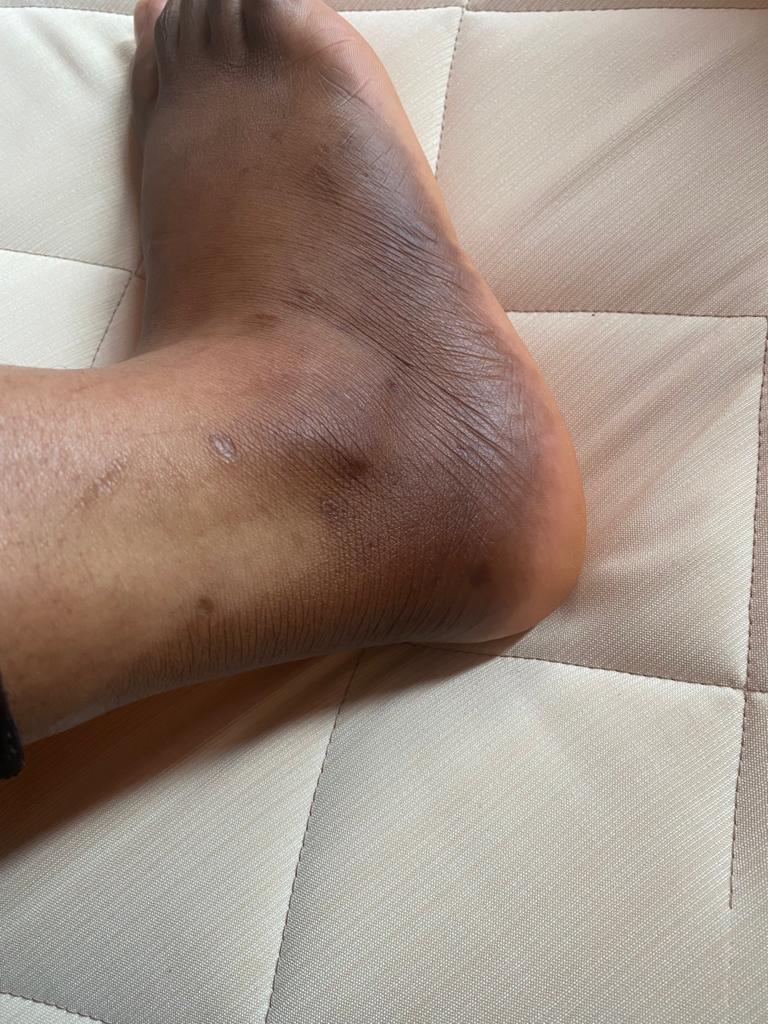 leg brightening before and after image of a customer