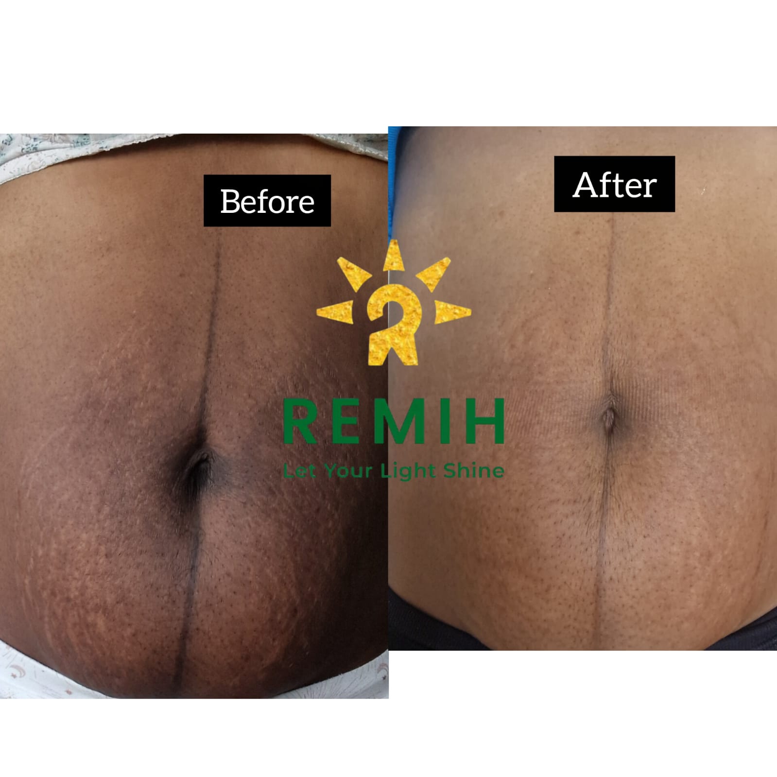 remih underarm before and after photo