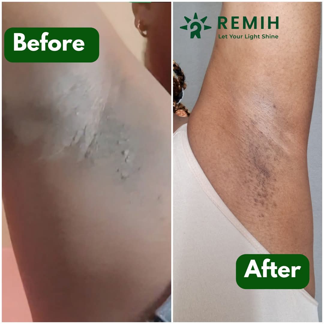 remih underarm before and after photo